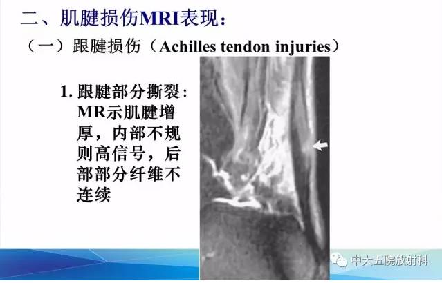 影像PPT - 【PPT】踝关节常见损伤的影像诊断-47