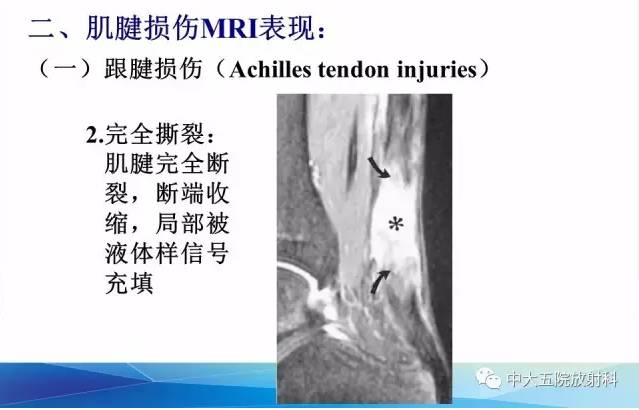 影像PPT - 【PPT】踝关节常见损伤的影像诊断-49