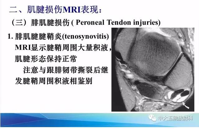 影像PPT - 【PPT】踝关节常见损伤的影像诊断-57