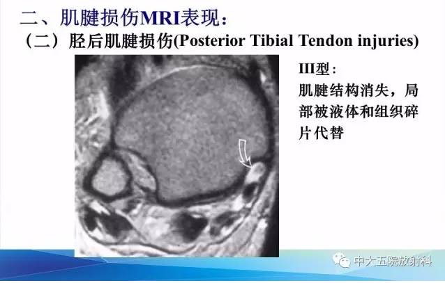 影像PPT - 【PPT】踝关节常见损伤的影像诊断-55