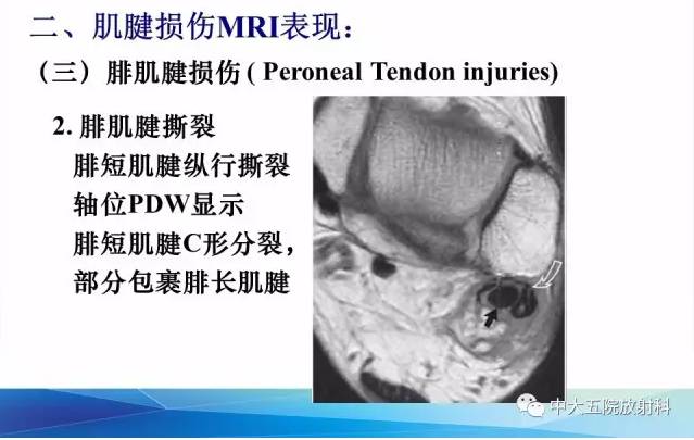 影像PPT - 【PPT】踝关节常见损伤的影像诊断-58
