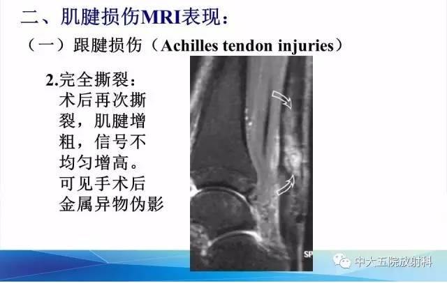 影像PPT - 【PPT】踝关节常见损伤的影像诊断-50