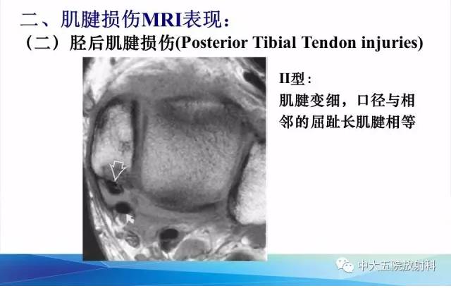 影像PPT - 【PPT】踝关节常见损伤的影像诊断-54