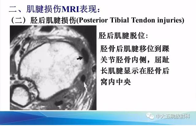 影像PPT - 【PPT】踝关节常见损伤的影像诊断-56