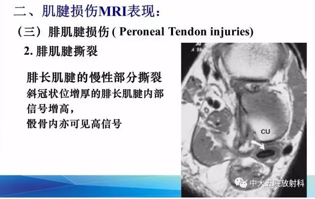 影像PPT - 【PPT】踝关节常见损伤的影像诊断-59