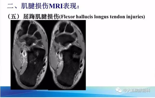 影像PPT - 【PPT】踝关节常见损伤的影像诊断-63