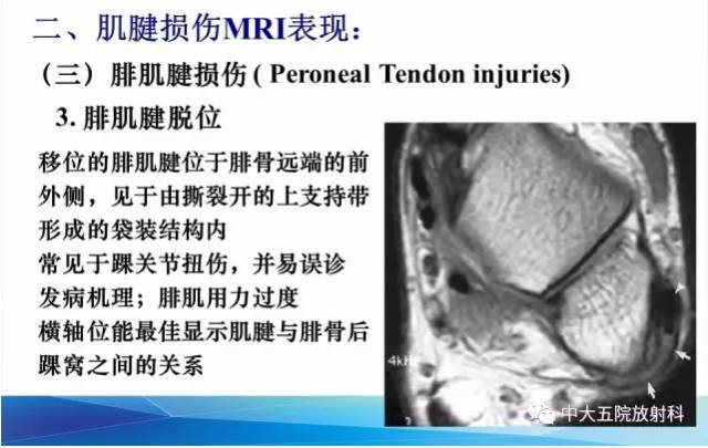 影像PPT - 【PPT】踝关节常见损伤的影像诊断-60