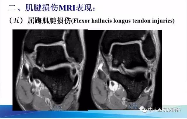 影像PPT - 【PPT】踝关节常见损伤的影像诊断-62