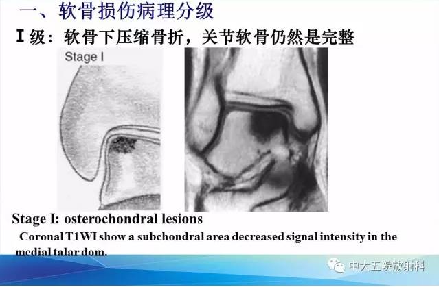 影像PPT - 【PPT】踝关节常见损伤的影像诊断-64