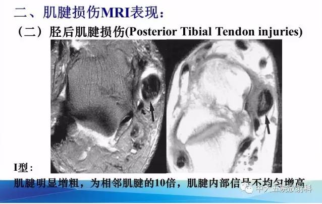 影像PPT - 【PPT】踝关节常见损伤的影像诊断-53