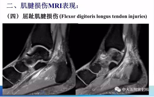 影像PPT - 【PPT】踝关节常见损伤的影像诊断-61