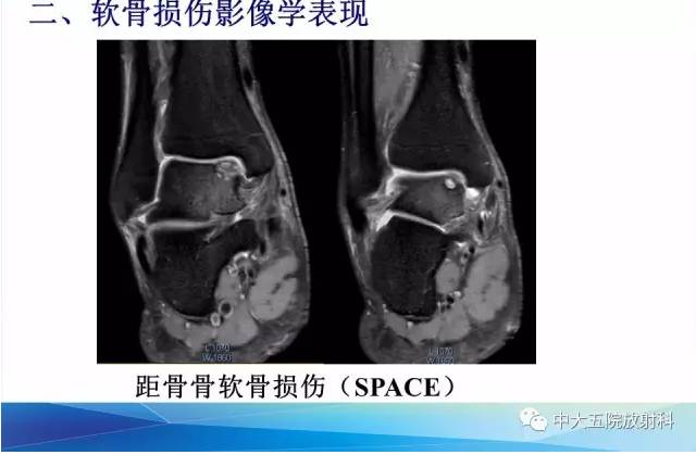 影像PPT - 【PPT】踝关节常见损伤的影像诊断-68