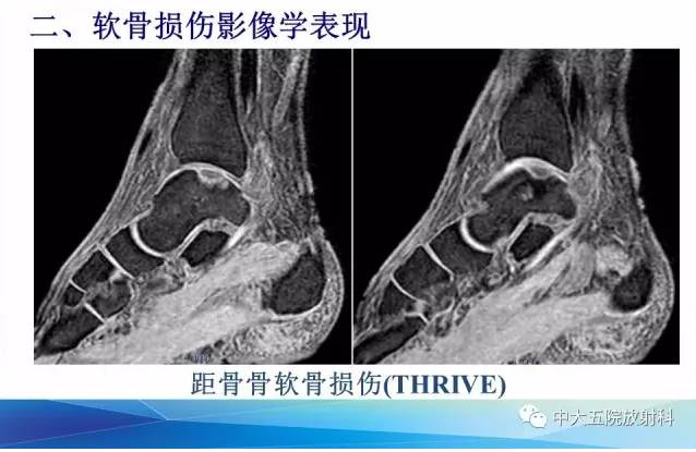 影像PPT - 【PPT】踝关节常见损伤的影像诊断-70
