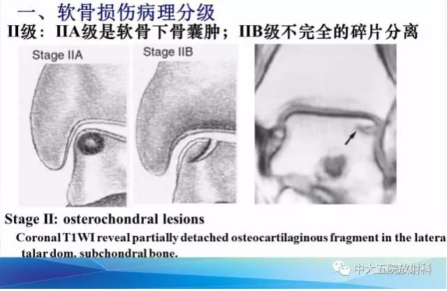 影像PPT - 【PPT】踝关节常见损伤的影像诊断-65