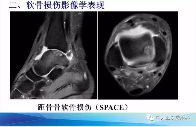 影像PPT - 【PPT】踝关节常见损伤的影像诊断-69