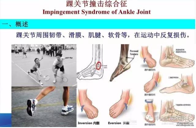 影像PPT - 【PPT】踝关节常见损伤的影像诊断-72