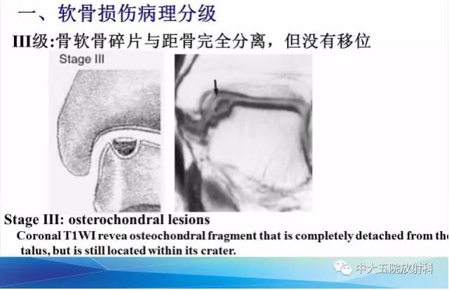 影像PPT - 【PPT】踝关节常见损伤的影像诊断-66