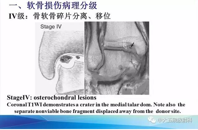 影像PPT - 【PPT】踝关节常见损伤的影像诊断-67