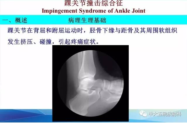 影像PPT - 【PPT】踝关节常见损伤的影像诊断-74
