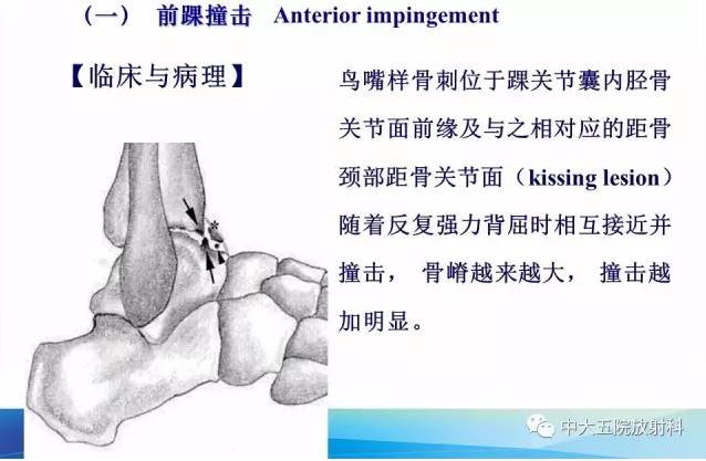 影像PPT - 【PPT】踝关节常见损伤的影像诊断-81