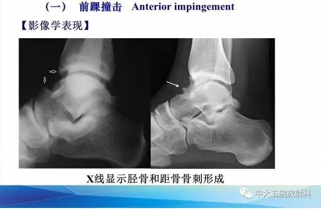 影像PPT - 【PPT】踝关节常见损伤的影像诊断-85
