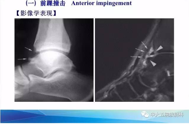 影像PPT - 【PPT】踝关节常见损伤的影像诊断-86