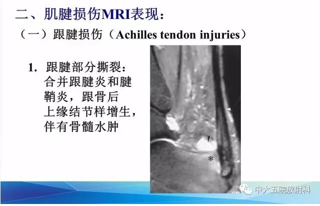 影像PPT - 【PPT】踝关节常见损伤的影像诊断-48