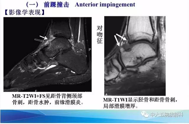 影像PPT - 【PPT】踝关节常见损伤的影像诊断-87
