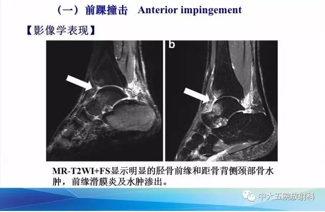 影像PPT - 【PPT】踝关节常见损伤的影像诊断-88