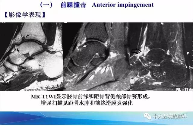 影像PPT - 【PPT】踝关节常见损伤的影像诊断-89