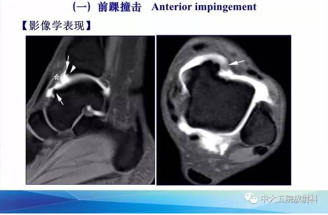 影像PPT - 【PPT】踝关节常见损伤的影像诊断-90