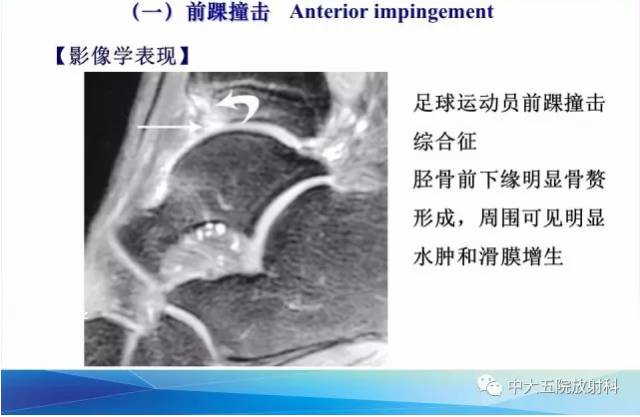 影像PPT - 【PPT】踝关节常见损伤的影像诊断-91