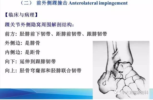 影像PPT - 【PPT】踝关节常见损伤的影像诊断-95