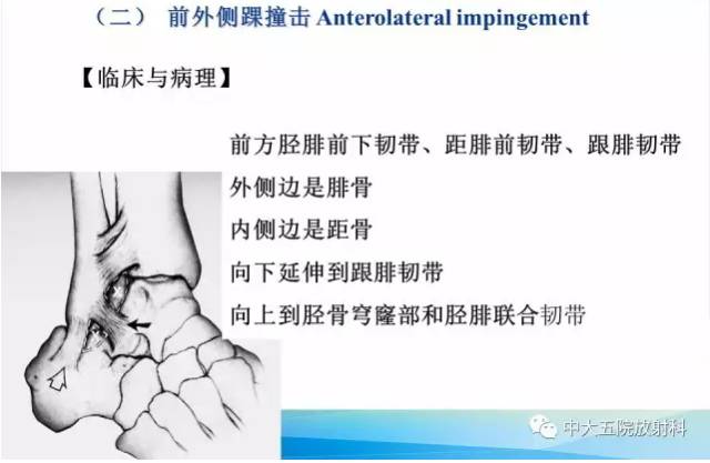 影像PPT - 【PPT】踝关节常见损伤的影像诊断-96