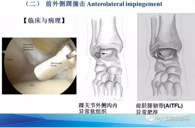 影像PPT - 【PPT】踝关节常见损伤的影像诊断-97