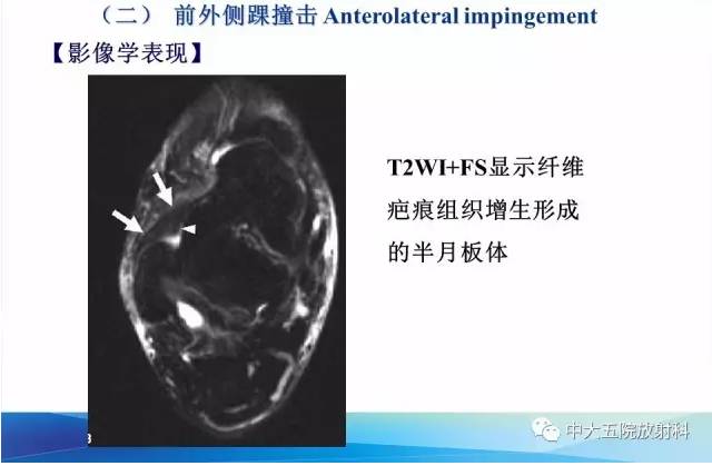 影像PPT - 【PPT】踝关节常见损伤的影像诊断-102