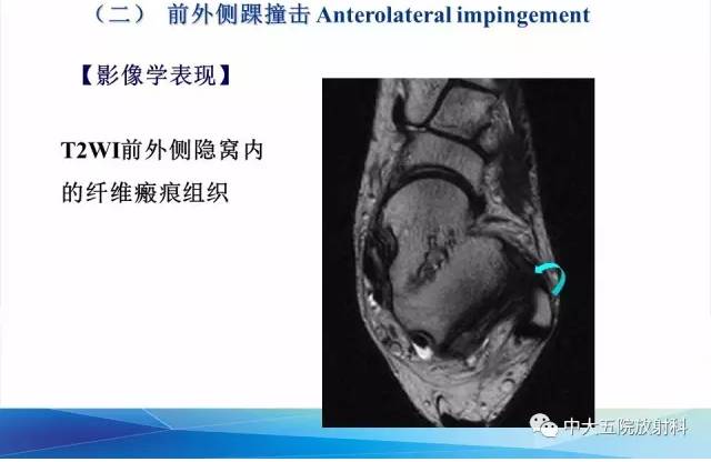 影像PPT - 【PPT】踝关节常见损伤的影像诊断-103