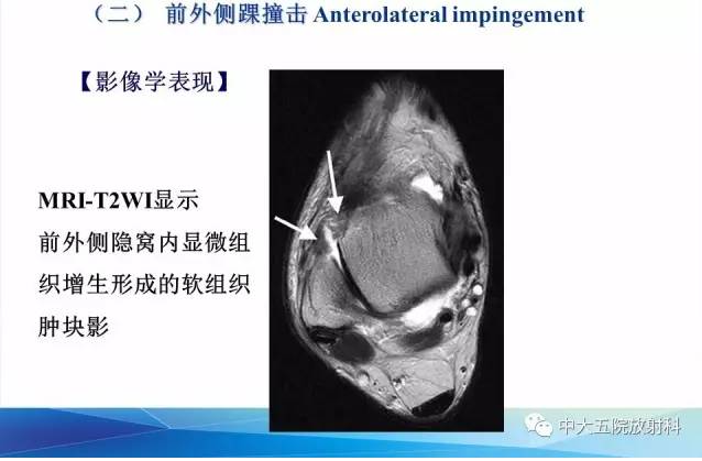 影像PPT - 【PPT】踝关节常见损伤的影像诊断-104
