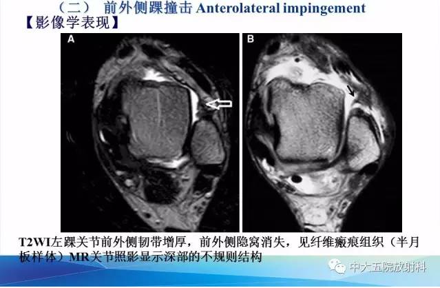 影像PPT - 【PPT】踝关节常见损伤的影像诊断-105
