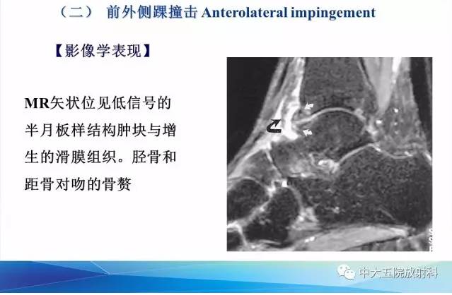 影像PPT - 【PPT】踝关节常见损伤的影像诊断-106