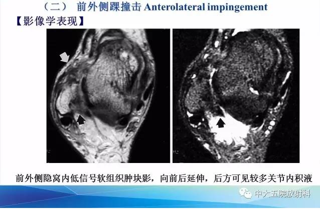 影像PPT - 【PPT】踝关节常见损伤的影像诊断-107