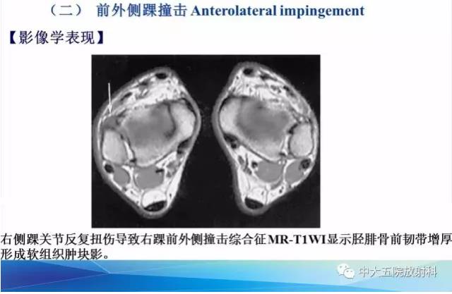 影像PPT - 【PPT】踝关节常见损伤的影像诊断-108