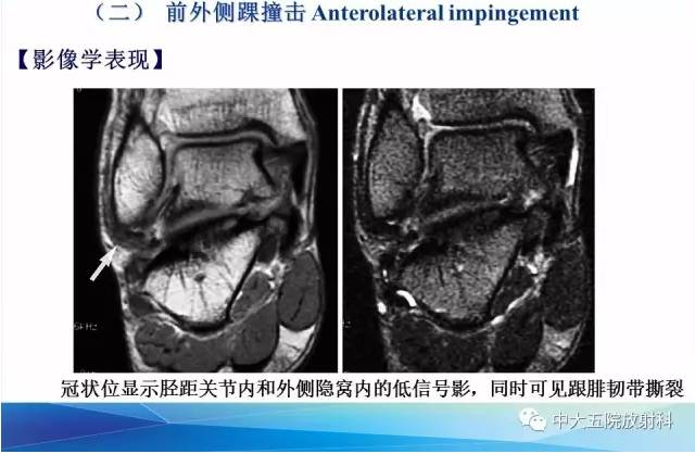 影像PPT - 【PPT】踝关节常见损伤的影像诊断-109