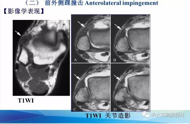 影像PPT - 【PPT】踝关节常见损伤的影像诊断-110