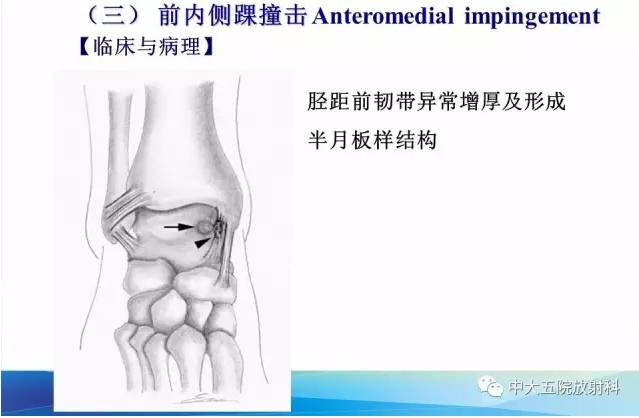 影像PPT - 【PPT】踝关节常见损伤的影像诊断-115