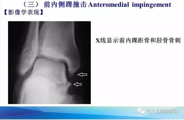 影像PPT - 【PPT】踝关节常见损伤的影像诊断-116
