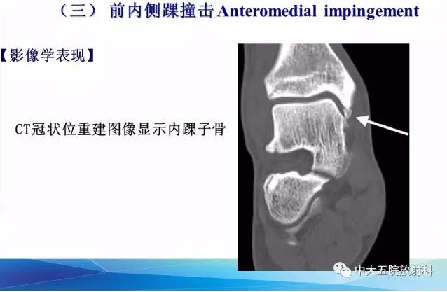 影像PPT - 【PPT】踝关节常见损伤的影像诊断-117
