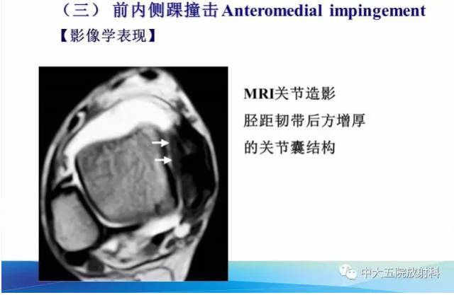 影像PPT - 【PPT】踝关节常见损伤的影像诊断-119