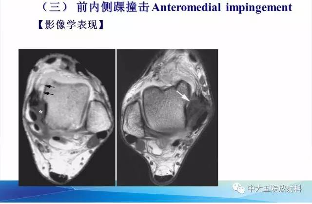 影像PPT - 【PPT】踝关节常见损伤的影像诊断-118