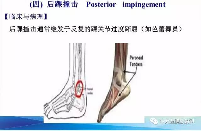 影像PPT - 【PPT】踝关节常见损伤的影像诊断-124